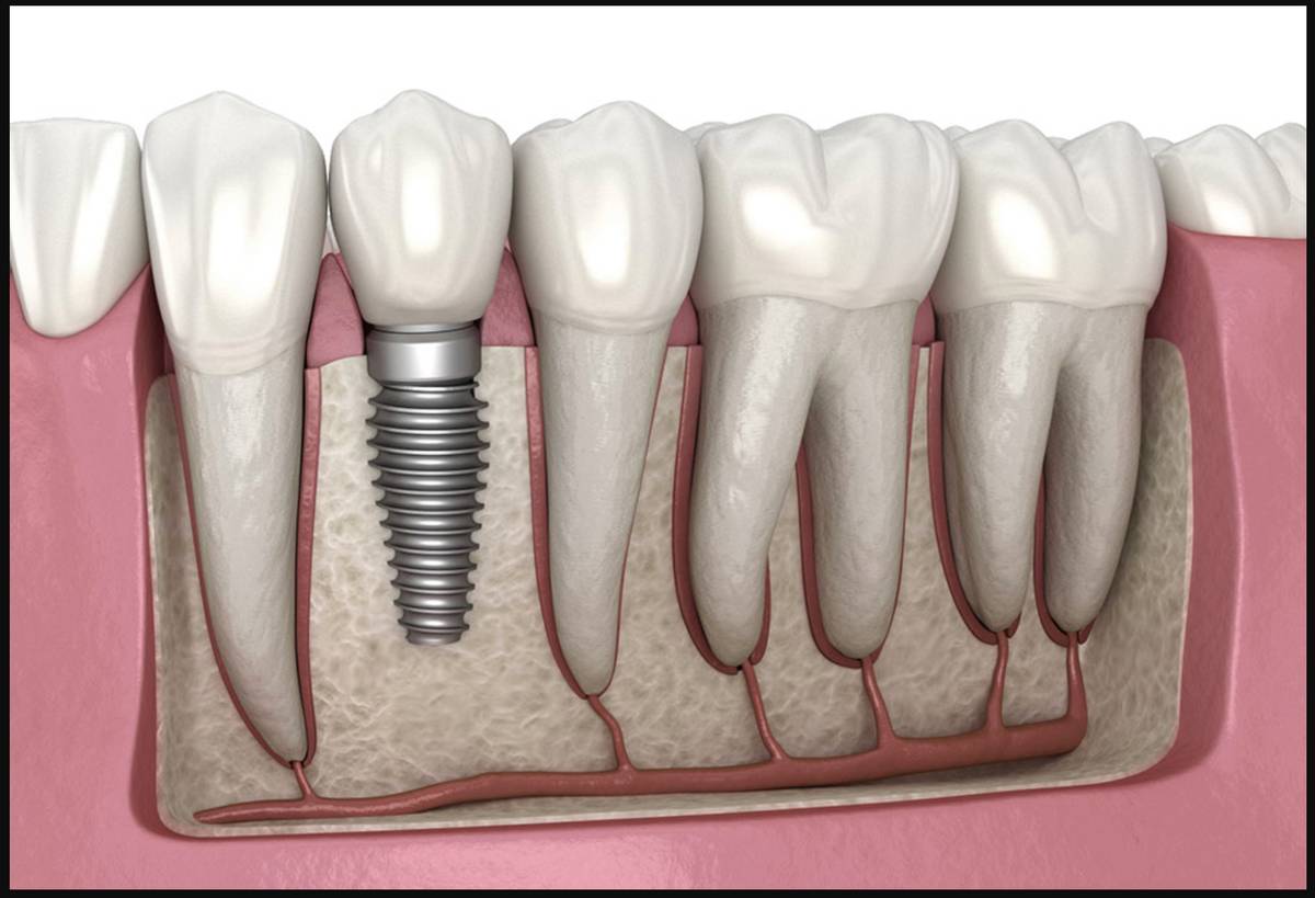 Osseointegrated Implants